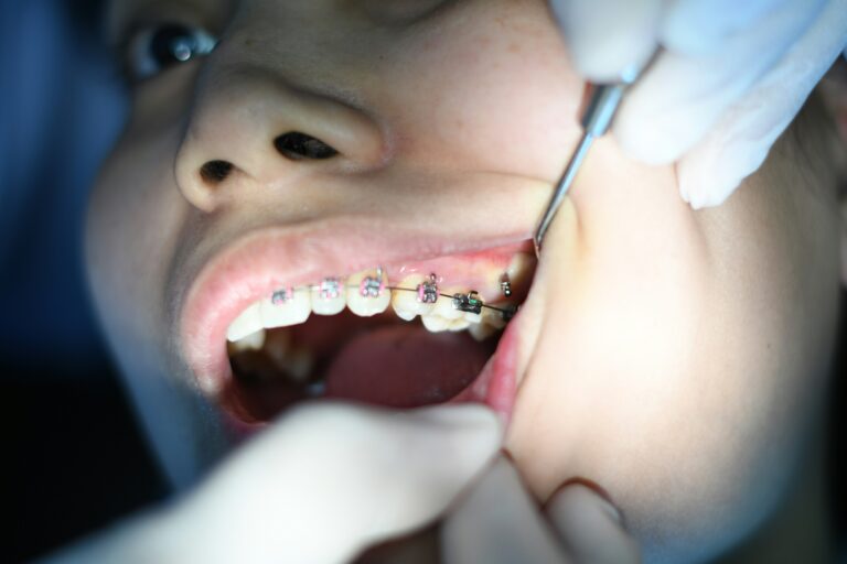 Jak długo trwa wykonanie mostu na implantach i ile wizyt potrzeba?