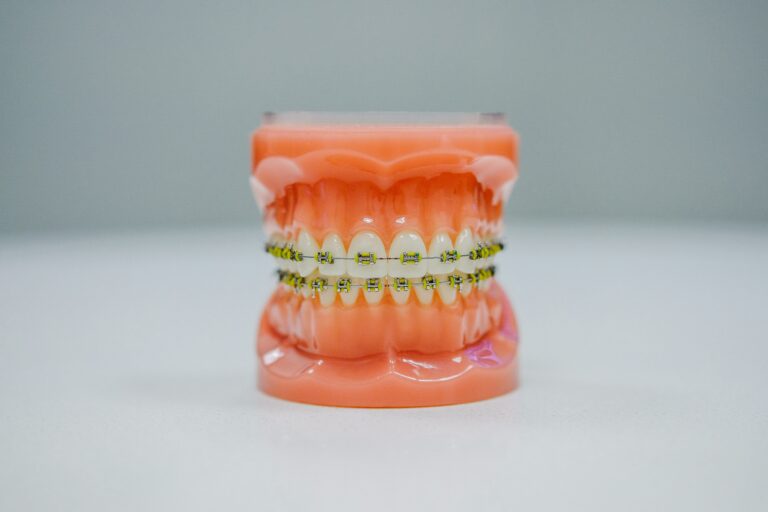 Jakie materiały stosuje się przy wykonaniu protez na implantach?