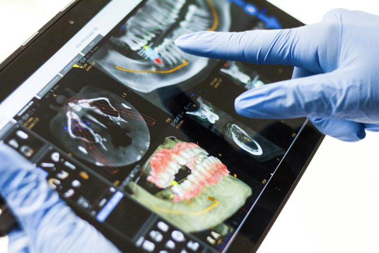 Proces Gojenia po Założeniu Mostu na Implantach: Przewodnik